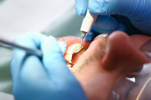 Best Emergency Wisdom Tooth Extraction in Morgantown, IN